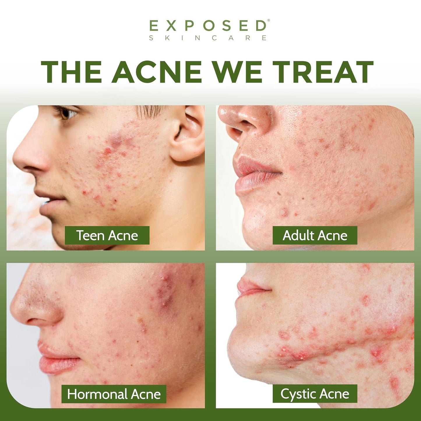 Clear Pore Serum - Green Tea, Licorice Root, Salicylic Acid - Unisex Skin Serum for Oily, Sensitive Skin